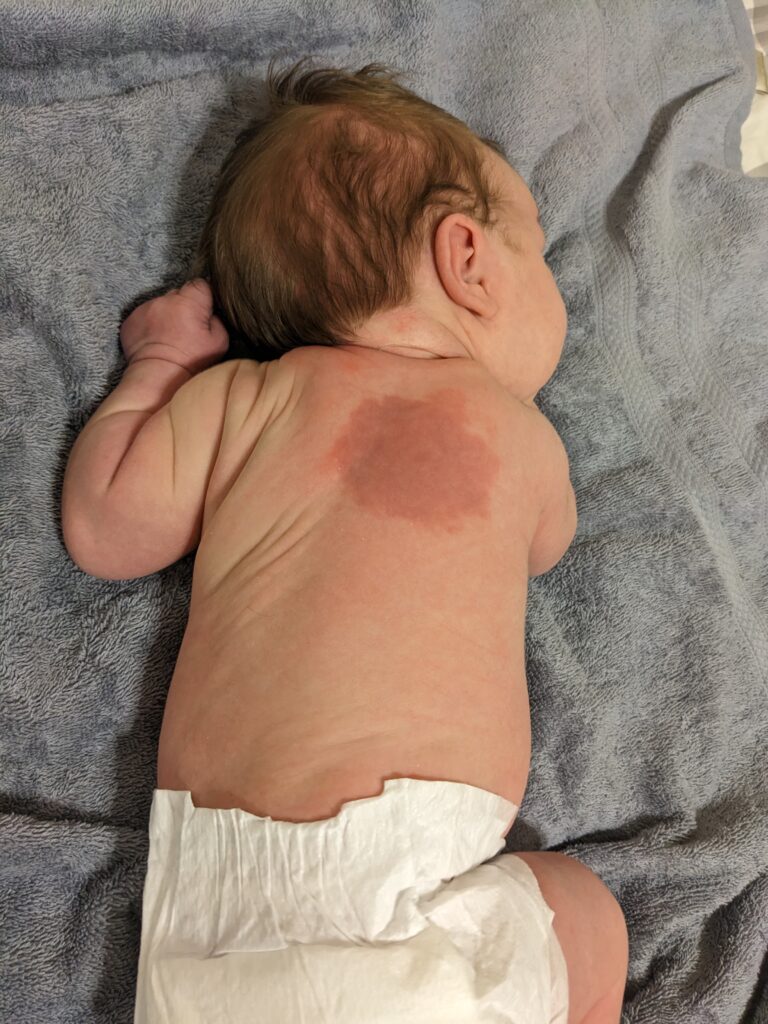 Port Wine Stain Birthmark